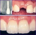 /album/dental-implant/implant-3-jpg/